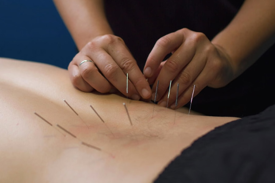 Dry Needling Therapist Cairns